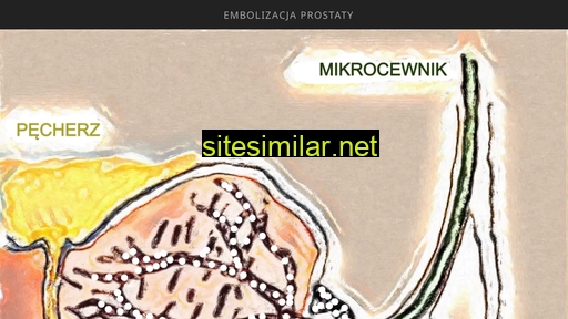 embolizacjaprostaty.pl alternative sites
